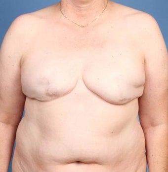 Breast Reconstruction