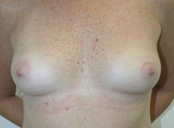 Breast Reconstruction