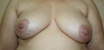 Breast Reconstruction