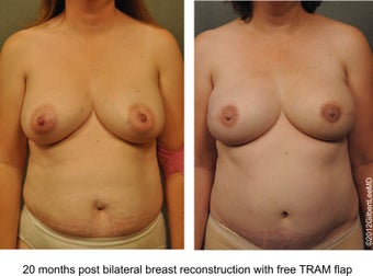 Breast Reconstruction