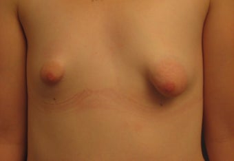 Reconstruction of Tubular Breast Deformity