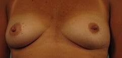 Bilateral Tissue Expander Reconstruction Following Mastectomy