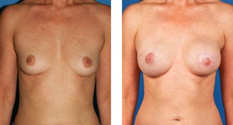 Breast Reconstruction: One-Stage Breast Reconstruction