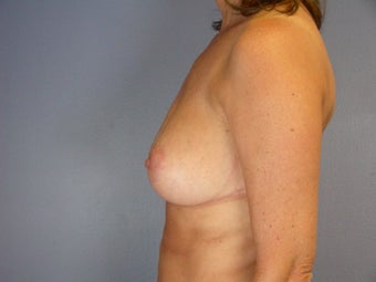 Breast Reduction 
