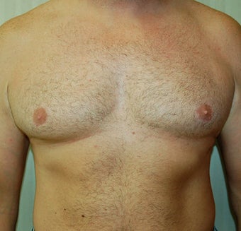 Male Breast Reduction