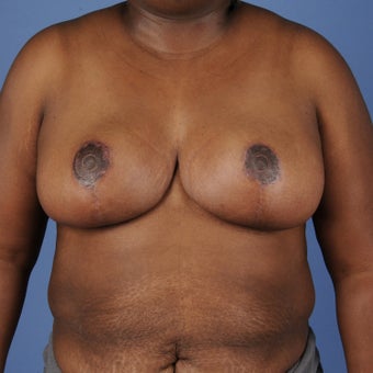 Breast Reduction