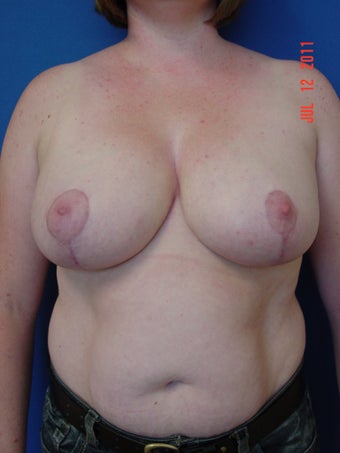 Breast Reduction