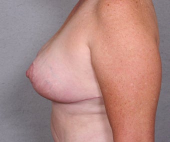 Breast Reduction