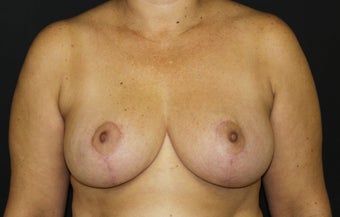 Breast Reduction