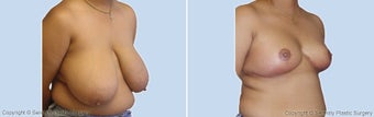 Breast Reduction, Breast Lift
