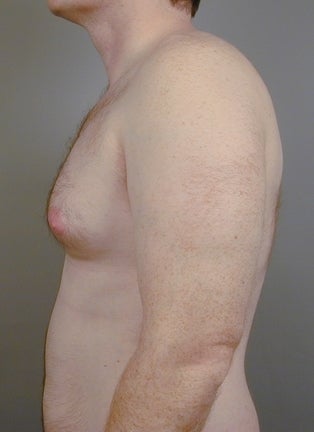 Breast Reduction