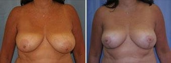 53 years old / breast reduction vertical technique