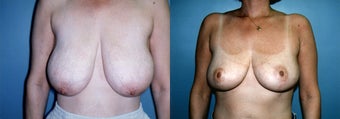 Breast Reduction & Mammoplasty
