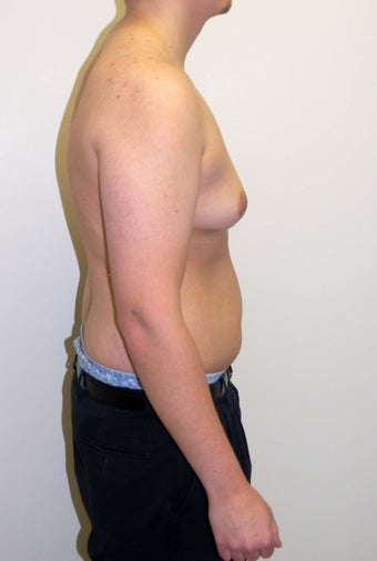 Gynecomastia
