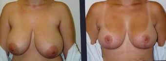 breast reduction