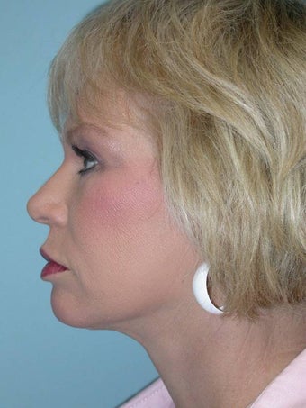 Full Facial Rejuvenation