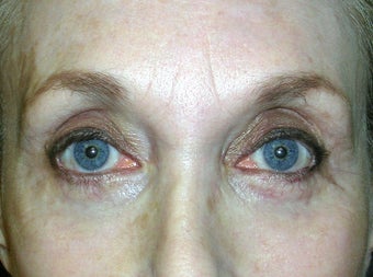 Upper Eyelid Ptosis Repair And Blepharoplasty; Lower Eyelid Blepharoplasty And Ectropion Repair; Endoscopic Brow Lift