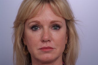 Endoscopic Forehead Lift