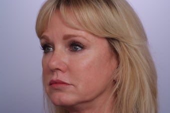 Endoscopic Brow Lift