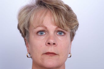Endoscopic Brow Lift