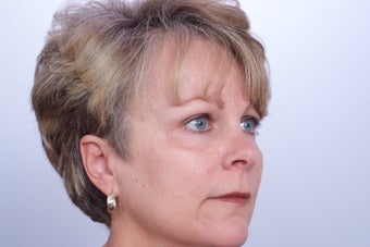 Endoscopic Brow Lift
