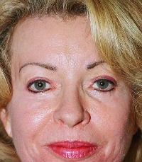 Forehead Lift (browlift)
