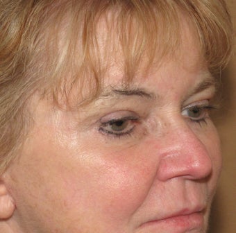 Blepharoplasty, endobrow