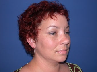 Before & After Endoscopic Browlift and Eyelid Lift
