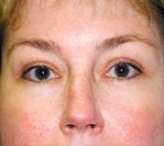 Endoscopic Brow Lift and Blepharoplasty