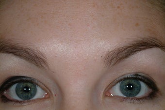 Chemical Brow lift