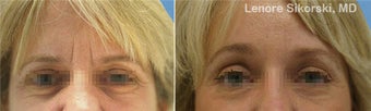 Endoscopic Browlift