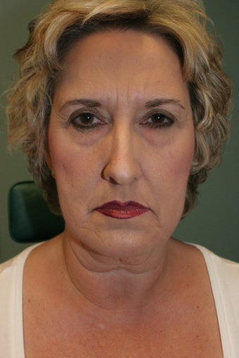 Total Facial Rejuvenation