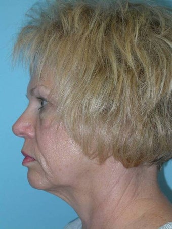 Full Facial Rejuvenation