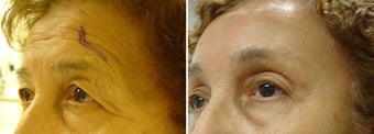 Coronal brow lift 