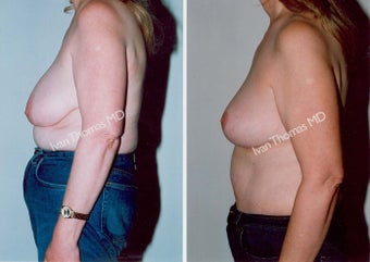 Mastopexy-Breast Lift