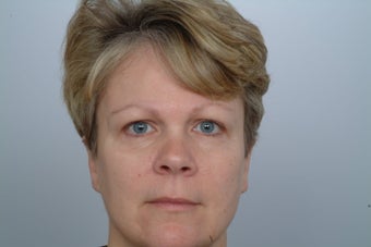 Endoscopic Brow Lift