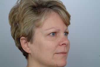 Endoscopic Brow Lift