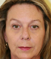 Forehead Lift (browlift)