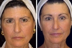 64 year old female, brow lift
