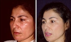 32 year old female, brow lift