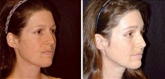 35 year old female, brow lift