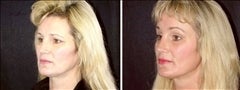 47 year old female, brow lift