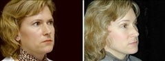 41 year old female, brow lift