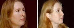 61 year old female, brow lift