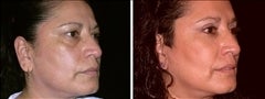 52 year old female, brow lift