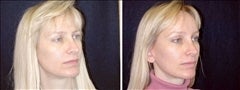 43 year old female, brow lift