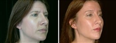 41 year old female, brow lift