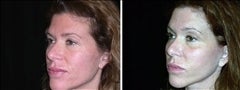 45 year old female, browl lift