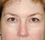 Endoscopic Brow Lift and Blepharoplasty