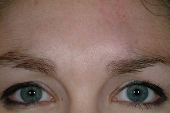 Chemical Brow lift